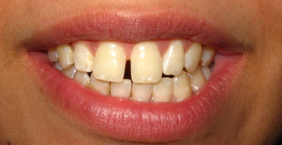uneven teeth with spaces
