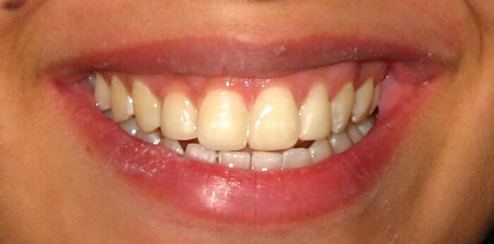 Smile Designing with Composite Bonding