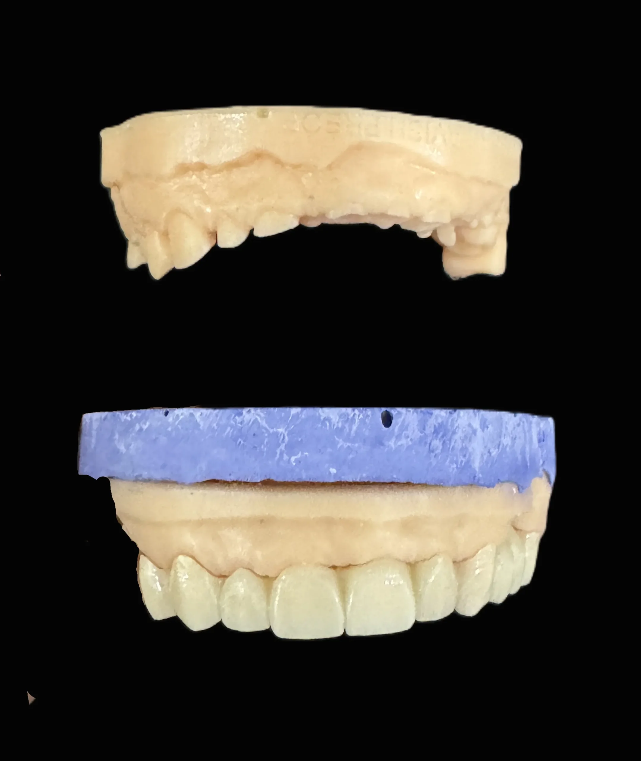 Full mouth rehabilitation clinical case at Dentessence