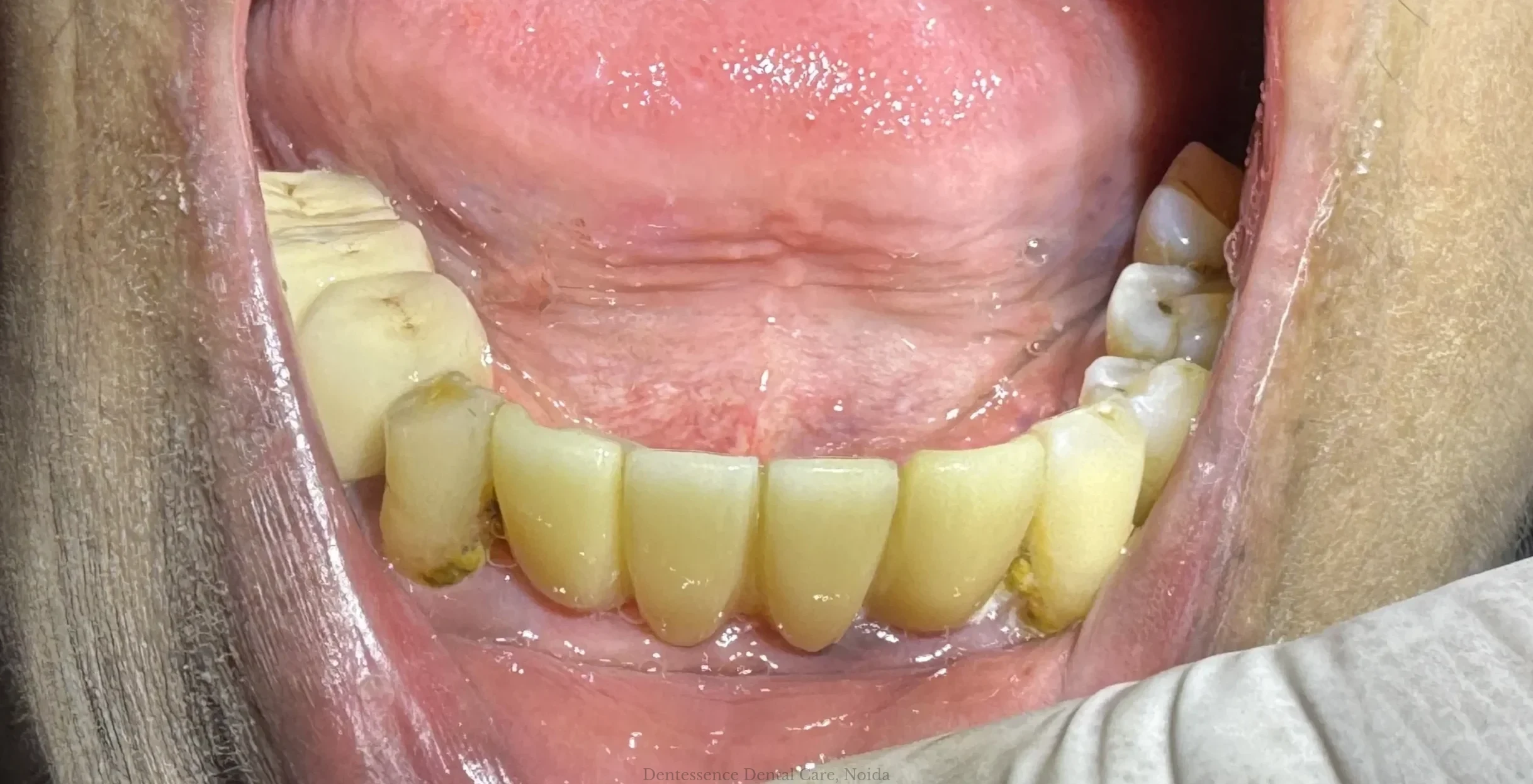 Intraoral clinical view showing final screw-retained zirconia bridge delivered over Ti-base link abutments restoring lower front teeth at Dentessence Dental Care Noida.