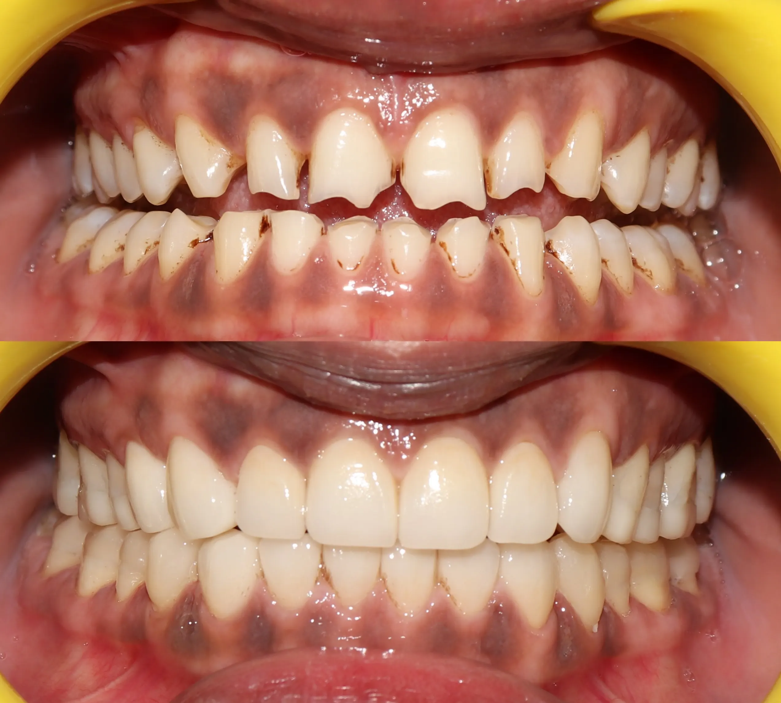 Before-and-after full mouth rehabilitation using E.max ceramic veneers, crowns and onlays